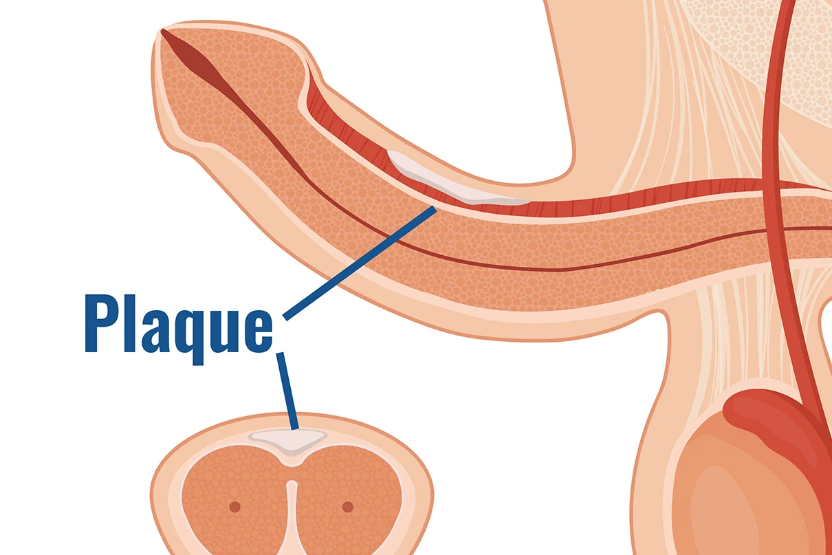 Schematische Darstellung einer Peyronie, die den Plaque zeigt - die Ursache dafür, dass der Penis krumm wird. Dieses Bild ist Teil der Webseite Behandlung einer Penisverkrümmung (IPP) in Köln des CUROS urologisches Zentrum Köln Bonn