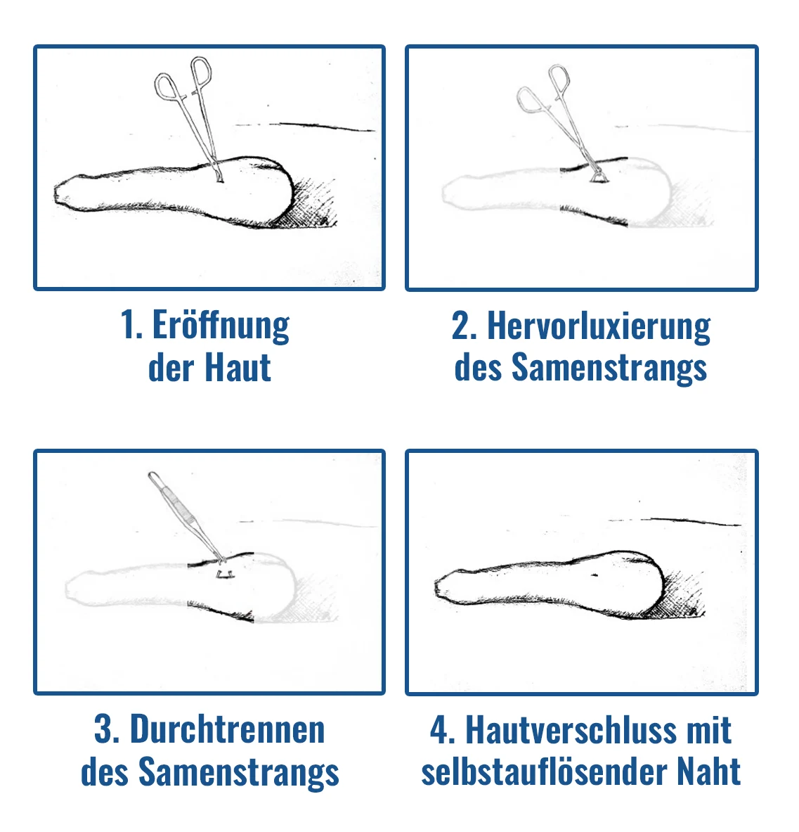 Ein grafisches Schaubild, dass in vier Stufen den Ablauf einer Vasketomie-Operation zeigt.