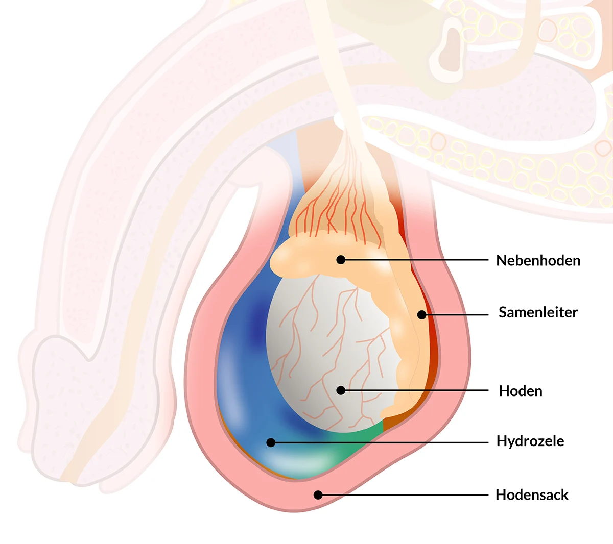 Schematische Darstellung einer Hydrozele - CUROS urologisches Zentrum Köln Bonn