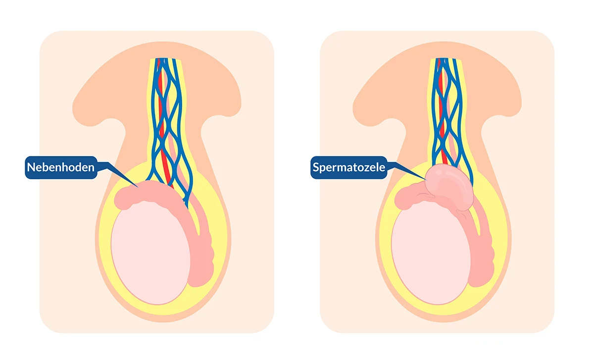 Schematische Darstellung einer Spermatozele - CUROS urologisches Zentrum Köln Bonn